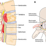 Spinal Infections