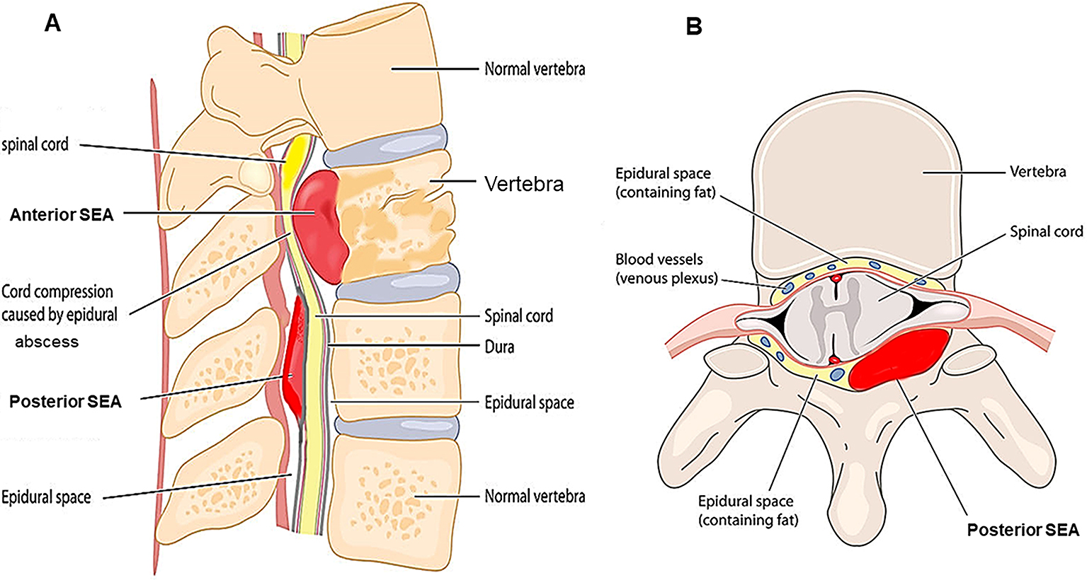 Spinal Infections