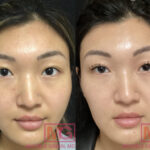 botox face slimming cost