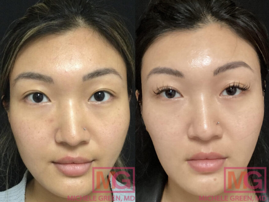 botox face slimming cost