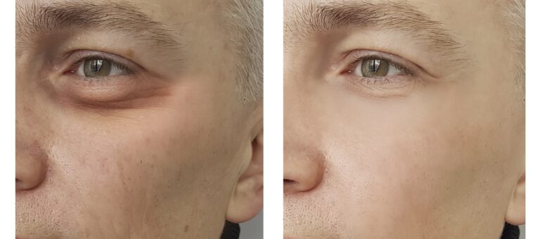 Tear Trough Filler Treatment