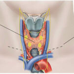 Thyroidectomy