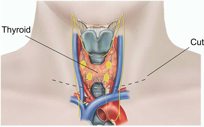 Thyroidectomy