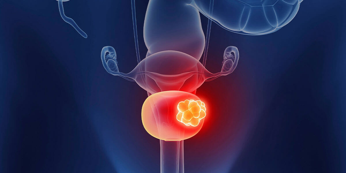 bladder cancer treatment