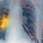 Non-Small Cell Lung Cancer Treatment Market