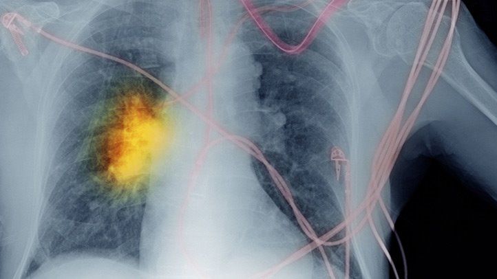 Non-Small Cell Lung Cancer Treatment Market