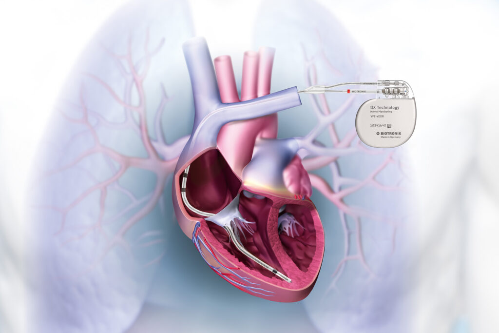 Cardiac Bio-Implants Device Market Size: Global Industry Trends, Share, Opportunity, and Forecast 2022-2030