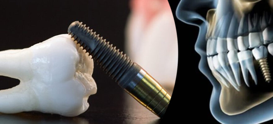 Same Day Dental Implants in Dubai