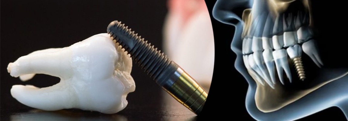 Same Day Dental Implants in Dubai