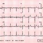 Enhancing Clinical Skills: The Importance of ECG Courses for Physician Assistants