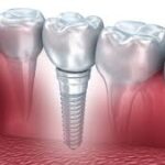 Unlocking the Secrets of Dental Implants