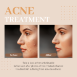 acne treatment