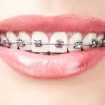 What Are the Advantages of Braces Installment Plans in Singapore?