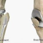 The Importance of Choosing the Right Surgeon for Hip and Knee Surgery