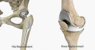 The Importance of Choosing the Right Surgeon for Hip and Knee Surgery