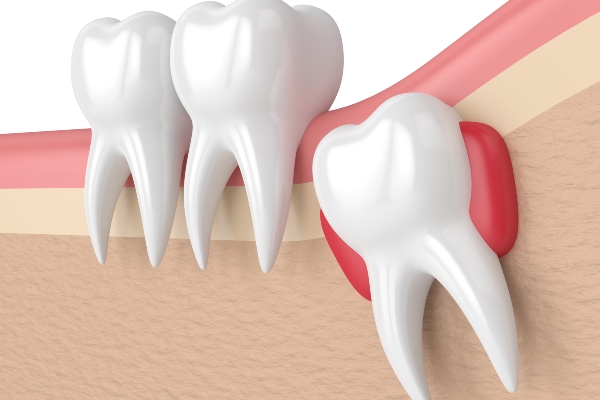 tooth cavity filling