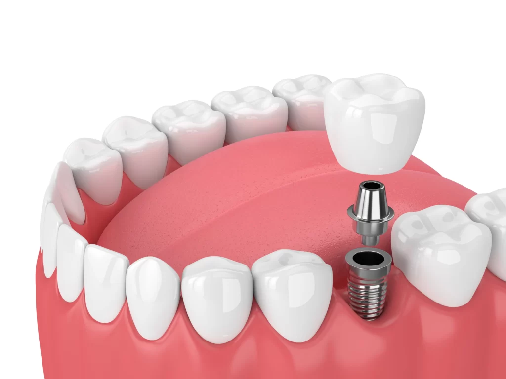 Advantages of Visiting a Root Canal Dentist for Wisdom Tooth Pain