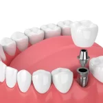 Advantages of Visiting a Root Canal Dentist for Wisdom Tooth Pain