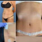 The Ideal Age for a Mini Tummy Tuck: Is There One?