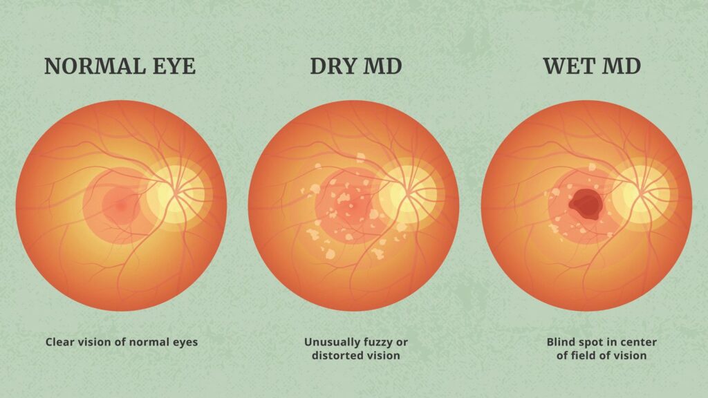 Age-Related Macular Degeneration (AMD) Market, Size, Share, Growth ⅼ Forecast (2023 – 2028) ⅼ Renub Research