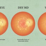 Age-Related Macular Degeneration (AMD) Market, Size, Share, Growth ⅼ Forecast (2023 – 2028) ⅼ Renub Research