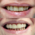 same day veneers near me