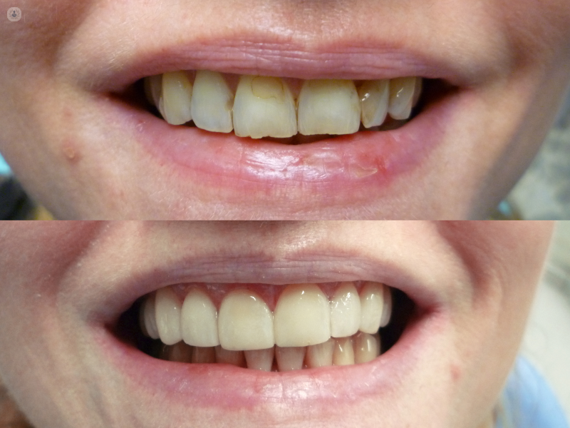 same day veneers near me