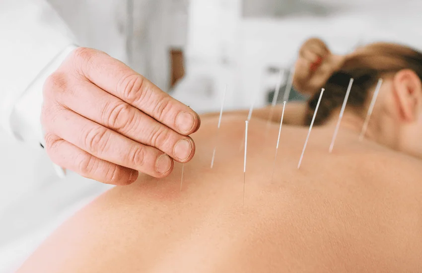 acupuncture