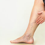 Varicose Veins