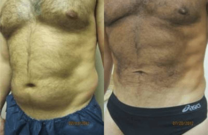 laser lipo dc