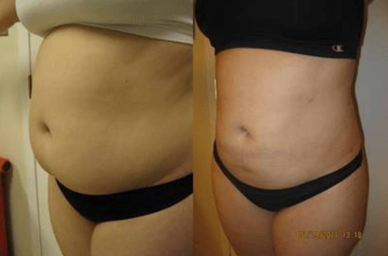 Laser Lipo In DC