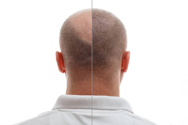 Hair transplant in Abu Dhabi