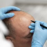 hair transplant package in turkey