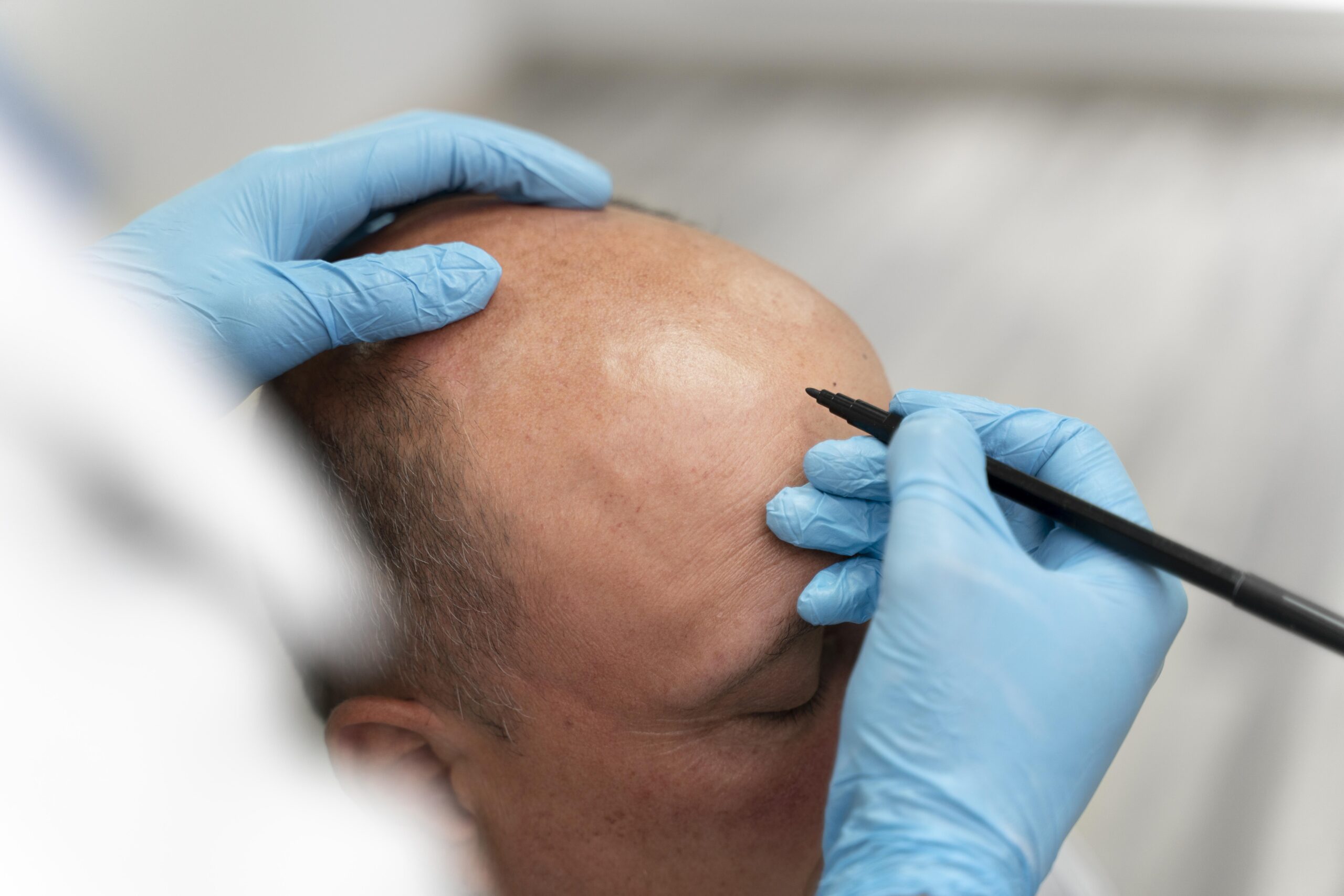 hair transplant package in turkey