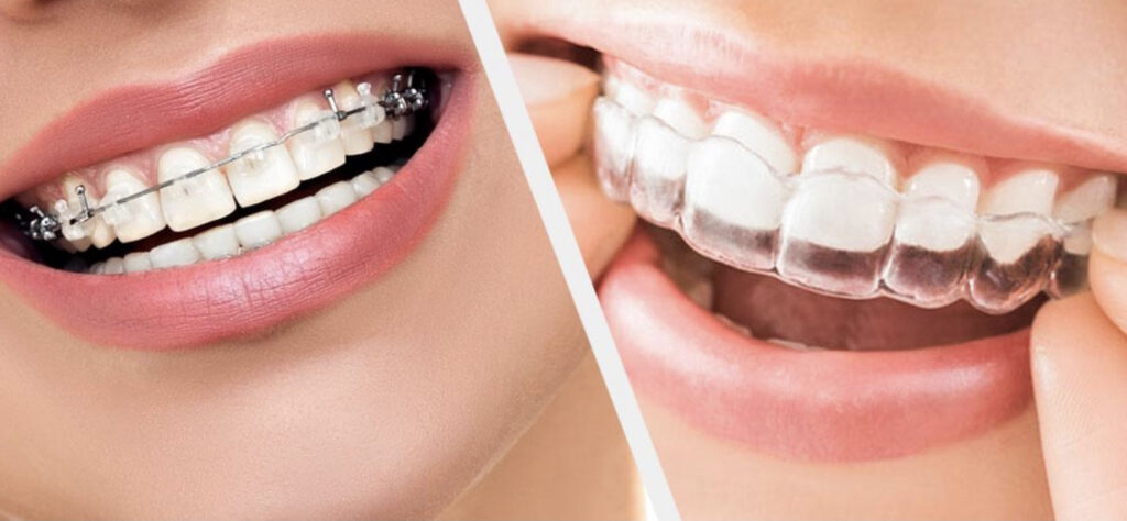 Straighten Your Teeth with Expert Orthodontic Care in Houston