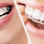 Straighten Your Teeth with Expert Orthodontic Care in Houston