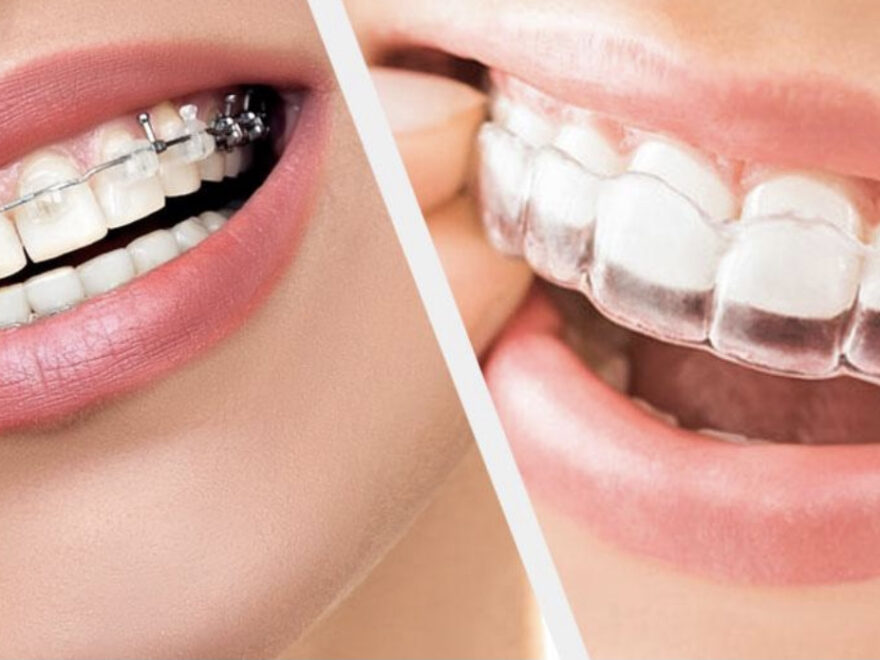 Straighten Your Teeth with Expert Orthodontic Care in Houston