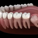 What Are the Signs of Root Canal and the Advantages of Dental Implants?