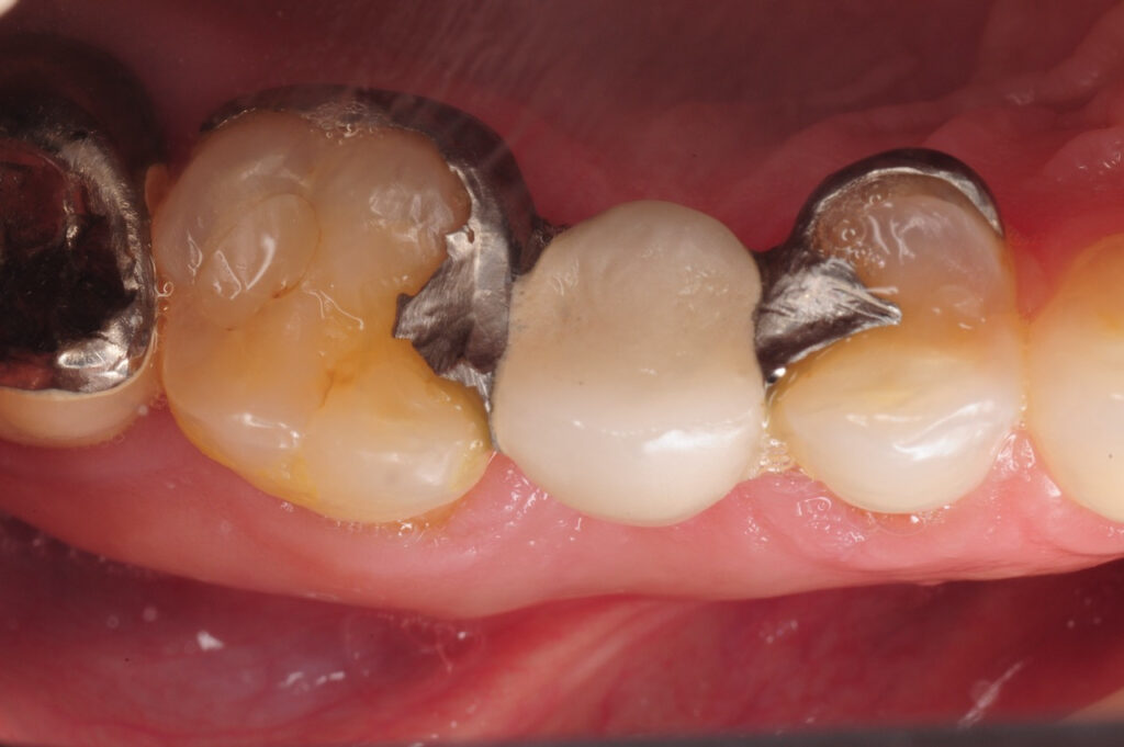 Composite Dental Fillings