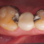 Composite Dental Fillings