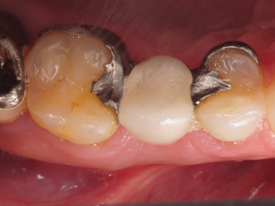 Composite Dental Fillings