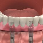 full mouth dental implants near me