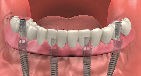 full mouth dental implants near me