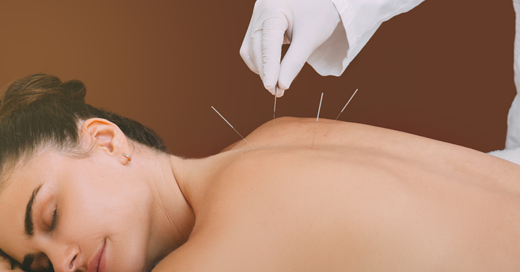 Best Acupuncture Hamilton