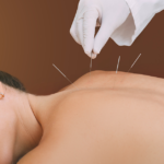 Best Acupuncture Hamilton