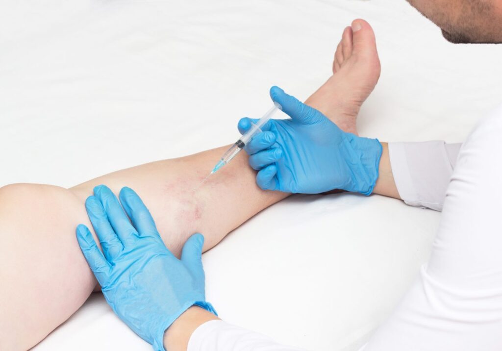 What To Avoid After Sclerotherapy