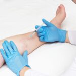 What To Avoid After Sclerotherapy