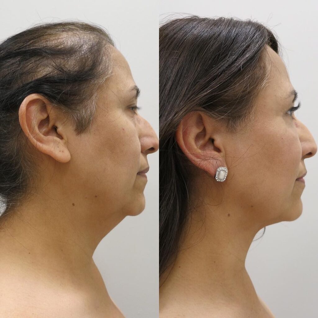 Cheek Reduction