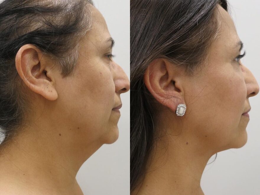 Cheek Reduction