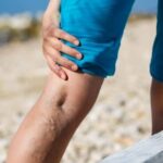 does medicare cover varicose vein treatment